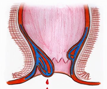 ​拉屎拉出血是什么原因?（大便带血到底是身体哪里出了问题？）