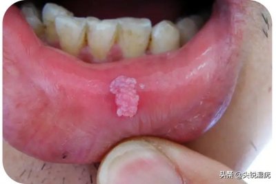 ​正常人口腔很难长尖锐湿疣吗