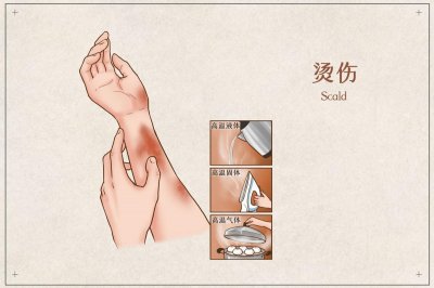 ​皮肤烫伤怎么办如何处理（皮肤烫伤如何做好应急处理？）