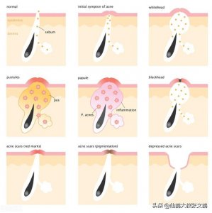 ​深度去黑头的好方法（各种去黑头偏方真的有效吗）