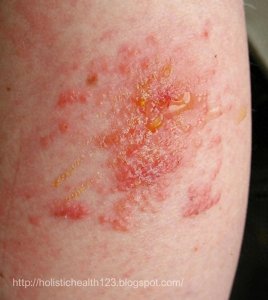 ​什么是湿疹？ 平常要怎么保养，才不会复发？